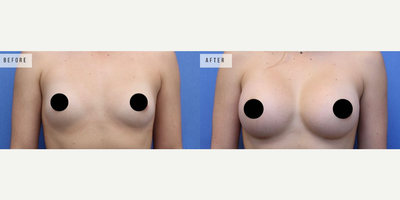 Case 7947 - Woman treated with Breast Augmentation, Breast Implants