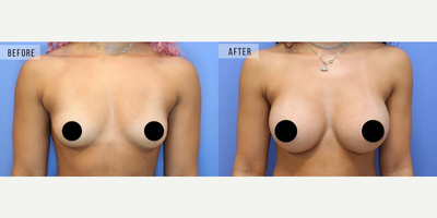 Case 7948 - Woman treated with Breast Augmentation, Breast Implants
