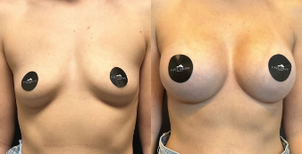 Case 7949 - Woman treated with Breast Augmentation, Breast Implants