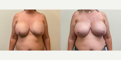 Case 7961 - Woman treated with Breast Augmentation