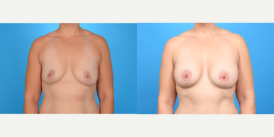 Case 7963 - 45-54 year old woman treated with Breast Implants, Breast Augmentation, Breast Lift with Implants, Inspira Breast Implants, Natr