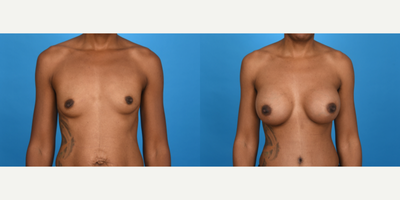 Case 7964 - 35-44 year old woman treated with Breast Implants, Breast Augmentation, Breast Lift with Implants, Inspira Breast Implants, Natr