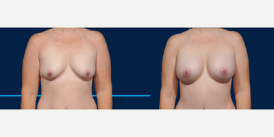 Case 7965 - Woman treated with Breast Augmentation