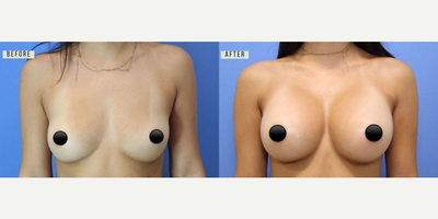 Case 7973 - Woman treated with Breast Augmentation, Breast Implants