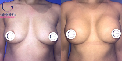 Case 7978 - Woman treated with Breast Augmentation
