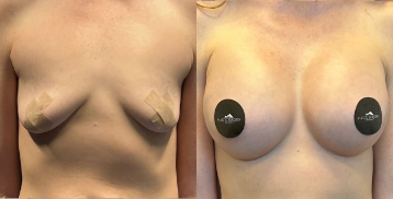 Case 7992 - Woman treated with Breast Augmentation, Breast Implants