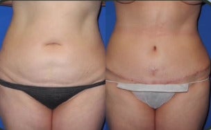 Case: 8 - before and after photo of Woman treated with Tummy Tuck by Shahram Salemy, MD, FACS