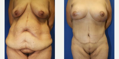 Case 80 - 35-44 year old woman treated with Tummy Tuck