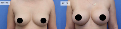Case 8000 - Woman treated with Breast Augmentation, Breast Implants