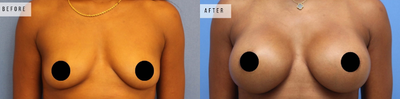 Case 8001 - Woman treated with Breast Augmentation, Breast Implants