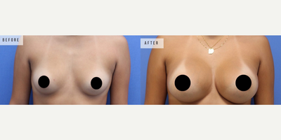 Case 8006 - Woman treated with Breast Augmentation, Breast Implants