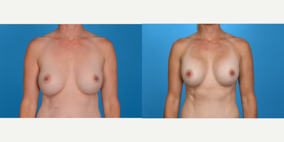 Case 8019 - 25-34 year old woman treated with Breast Augmentation, Breast Implant Revision, Natrelle Breast Implants, Inspira Breast Implant