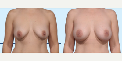 Case 8021 - Woman treated with Breast Augmentation