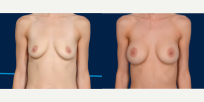Case 8022 - Woman treated with Breast Augmentation