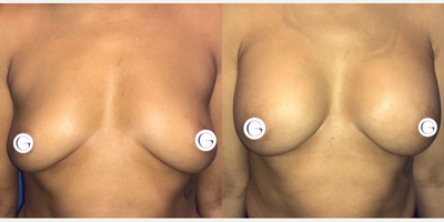 Case 8025 - Woman treated with Breast Augmentation