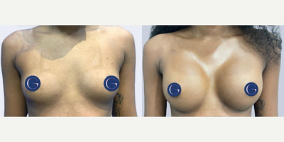Case 8028 - Woman treated with Breast Augmentation