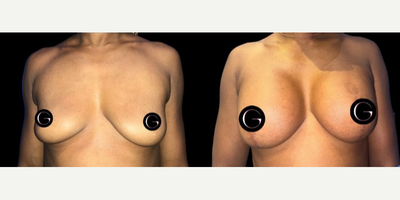 Case 8029 - Woman treated with Breast Augmentation