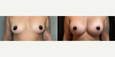 Case: 8032 - before and after photo of Woman treated with Breast Implants by S. Alexander Earle, MD, FACS