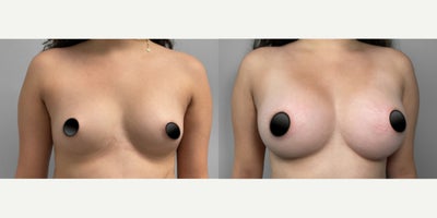 Case: 8033 - before and after photo of Woman treated with Breast Implants by S. Alexander Earle, MD, FACS
