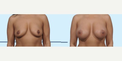 Case: 8034 - before and after photo of Woman treated with Breast Implants by John L. Burns Jr., MD
