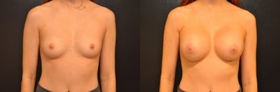 Case: 8039 - before and after photo of Woman treated with Breast Augmentation, Breast Implants by Robert L. Steely, MD, FACS