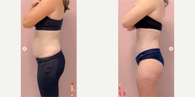 Case 804 - 35-44 year old woman treated with Tummy Tuck