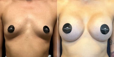 Case 8042 - Woman treated with Breast Augmentation, Breast Implants