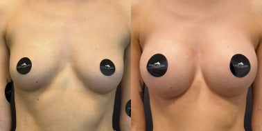 Case 8043 - Woman treated with Breast Augmentation, Breast Implants
