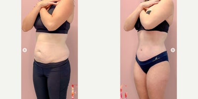 Case 805 - 35-44 year old woman treated with Tummy Tuck