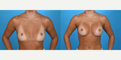 Case 8050 - 25-34 year old woman treated with Breast Implants, Breast Augmentation, Inspira Breast Implants, Natrelle Breast Implants