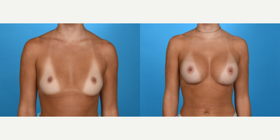 Case 8051 - 25-34 year old woman treated with Breast Implants, Breast Augmentation, Inspira Breast Implants, Natrelle Breast Implants