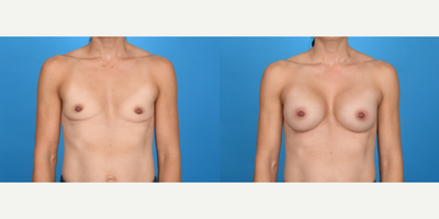 Case 8052 - 35-44 year old woman treated with Breast Implants, Inspira Breast Implants, Natrelle Breast Implants, Breast Augmentation