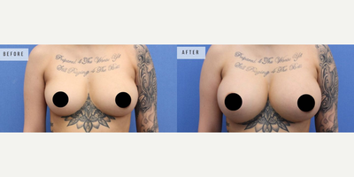 Case 8053 - Woman treated with Breast Augmentation, Breast Implants