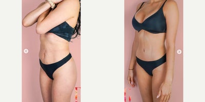 Case 806 - 35-44 year old woman treated with Mommy Makeover, Tummy Tuck, Breast Lift with Implants