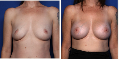 Case 8063 - 35-44 year old woman treated with Natrelle Breast Implants, Breast Implants, Breast Augmentation