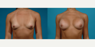 Case 8064 - 18-24 year old woman treated with Breast Implants, Breast Augmentation, Inspira Breast Implants, Natrelle Breast Implants