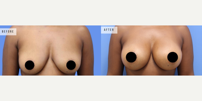 Case 8065 - Woman treated with Breast Augmentation, Breast Implants