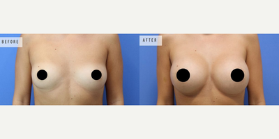 Case 8066 - Woman treated with Breast Augmentation, Breast Implants
