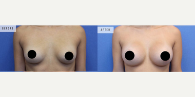 Case 8069 - Woman treated with Breast Augmentation, Breast Implants