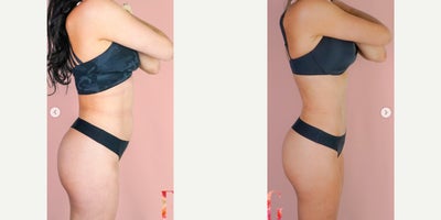 Case 807 - 35-44 year old woman treated with Mommy Makeover, Tummy Tuck, Breast Lift with Implants