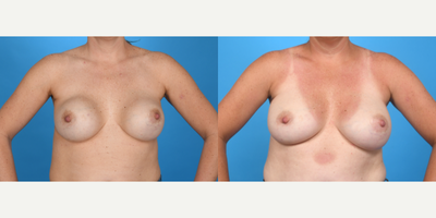 Case 8073 - 45-54 year old woman treated with Breast Implants, Inspira Breast Implants, Natrelle Breast Implants, Breast Implant Revision