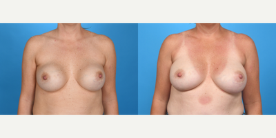 Case 8074 - 45-54 year old woman treated with Breast Implants, Inspira Breast Implants, Natrelle Breast Implants, Breast Implant Revision