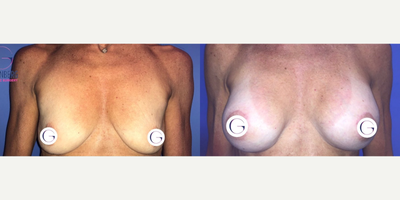 Case 8075 - Woman treated with Breast Implants