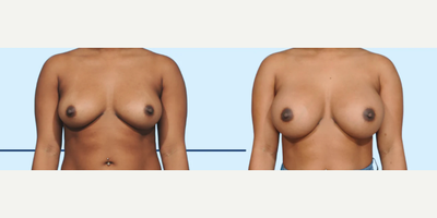 Case 8079 - Woman treated with Breast Augmentation