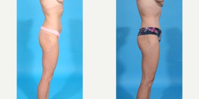 Case 809 - 45-54 year old woman treated with Abdominal Etching, Tummy Tuck, Mini Tummy Tuck, Drainless Tummy Tuck, Liposuction, Vaser Lipos