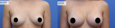 Case 8090 - Woman treated with Breast Augmentation, Breast Implants