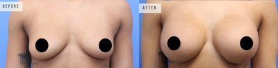 Case 8091 - Woman treated with Breast Augmentation, Breast Implants