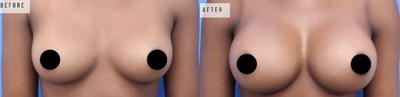 Case 8095 - Woman treated with Breast Augmentation, Breast Implants