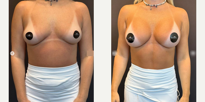 Case 8096 - Woman treated with Breast Augmentation, Breast Implants