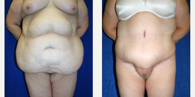 Case 81 - 45-54 year old woman treated with Tummy Tuck